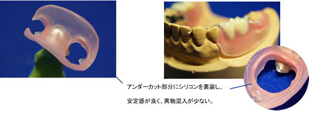 ノンクラスプデンチャー